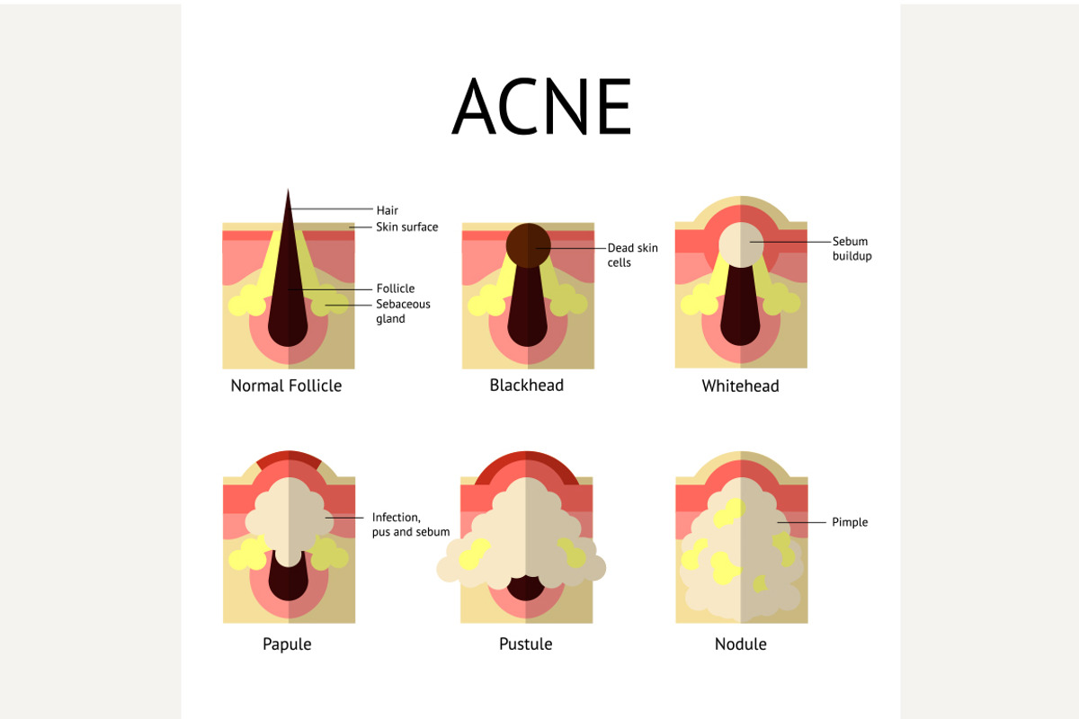 Types of acne pimples. Healthy skin, a Graphic by Shanvood art
