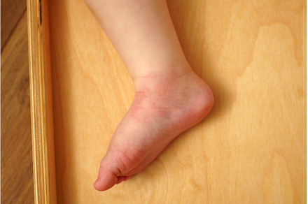 Redness from mosquito bite on a baby
