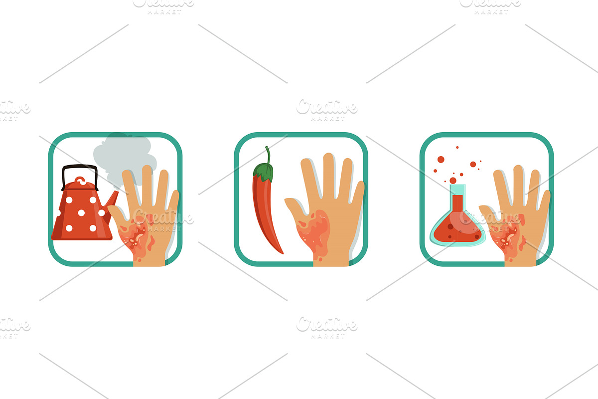 Types of Burns Set, Thermal, an Object Illustration by TopVectors