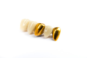 Dental ceramic and gold tooth crowns on white background isolated containing