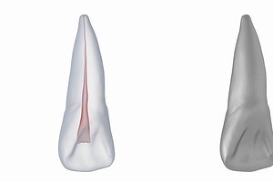 Upper Central Incisor With Pulp