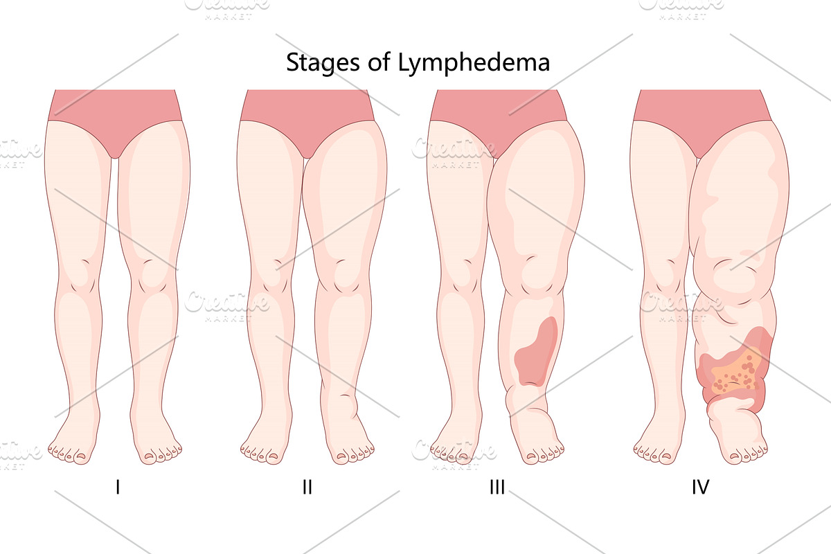 Lymphedema Stages in Legs structure, a Healthcare Illustration by AlexArt
