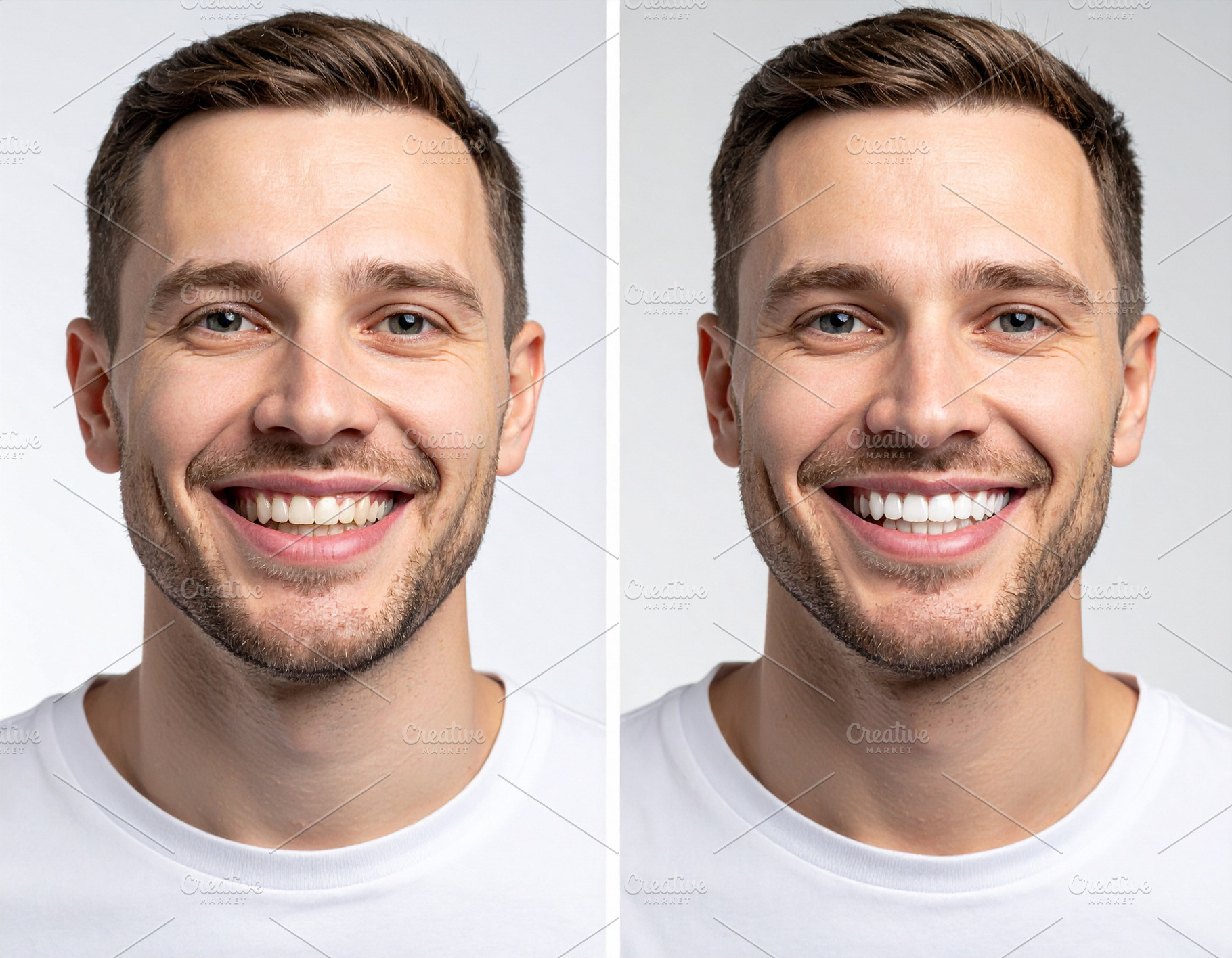 Before-and-after photo composition of a dental whitening treatme, a Health & Medical Photo by DanFLCreativo
