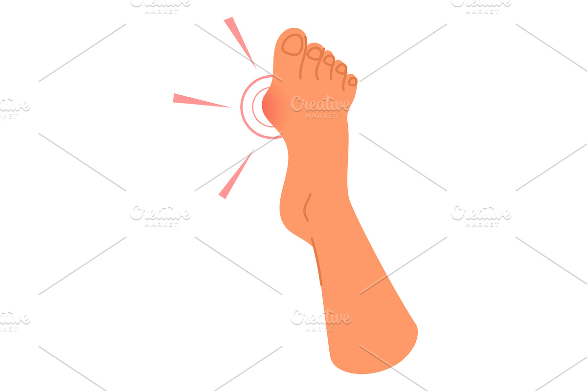 Foot of person with enlarged joint, a Healthcare Illustration by Vectorbuum