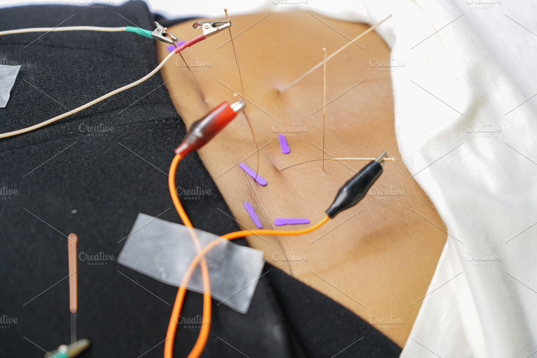 doctor sticks needles into the girl's back on acupuncture with E, a Health & Medical Photo by Casanowe-studio