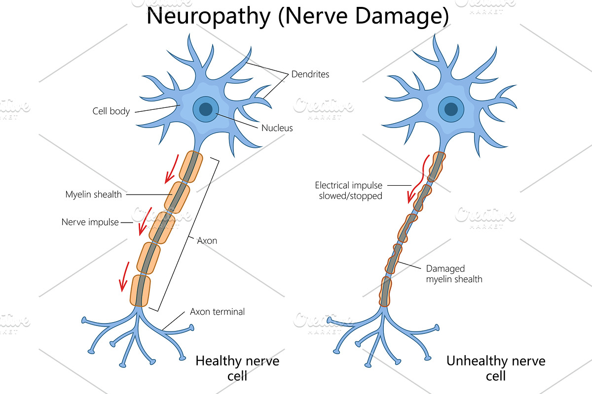 Medical Diagram of Neuropathy and, a Healthcare Illustration by AlexArt