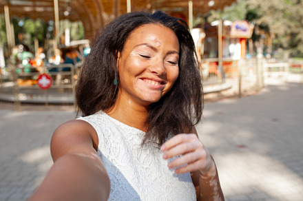 Happy woman with vitiligo skin problem taking selfie in city park