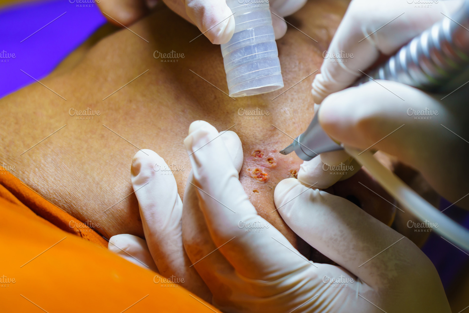 close up cosmetology procedure laser freckle skin removal on bod, a Health & Medical Photo by Casanowe-studio