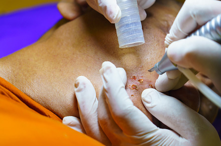 close up cosmetology procedure laser freckle skin removal on bod, a Health & Medical Photo by Casanowe-studio