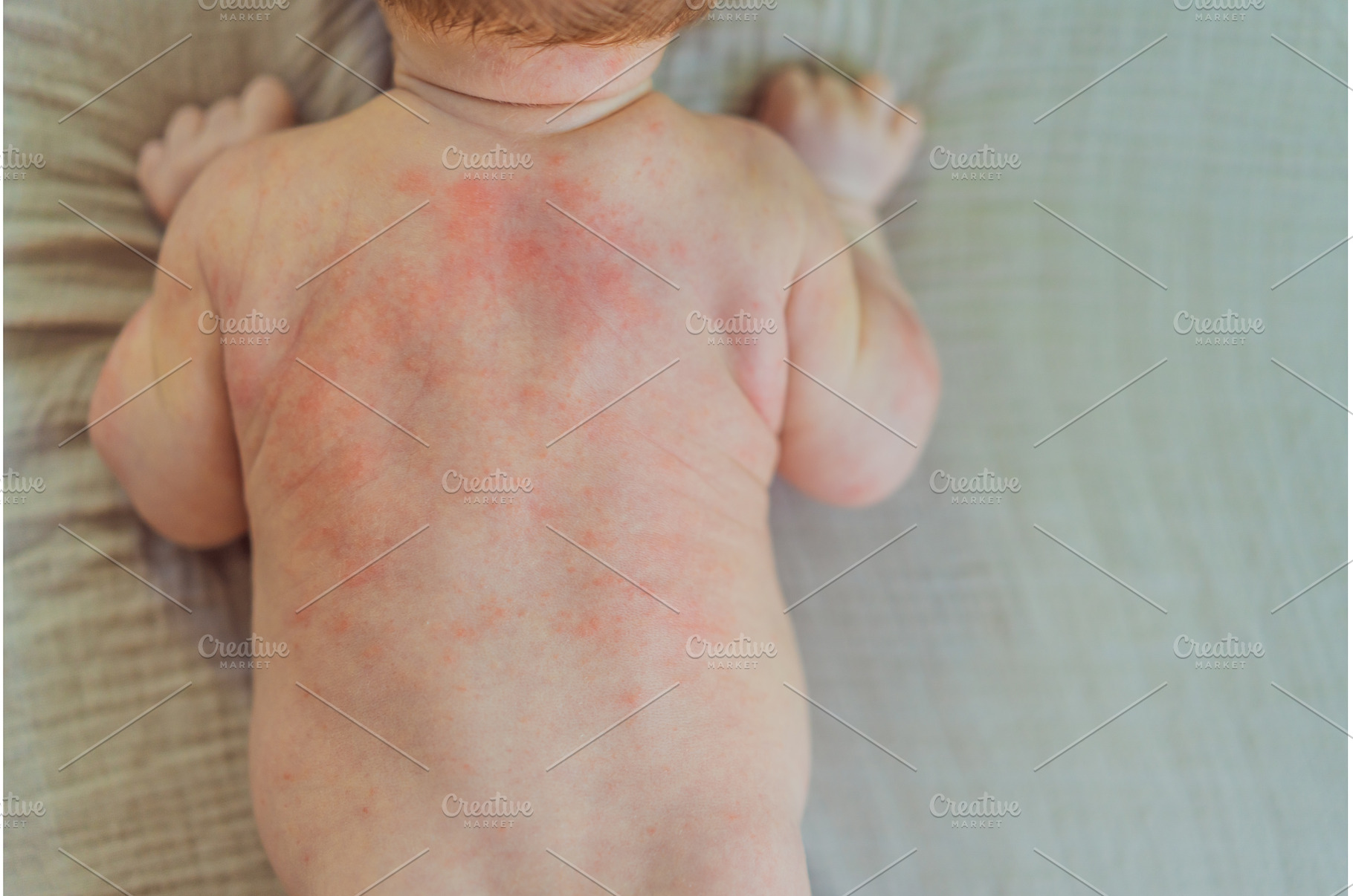 Severe heat rash on newborn baby, a Health & Medical Photo by Elizaveta Galitskaya