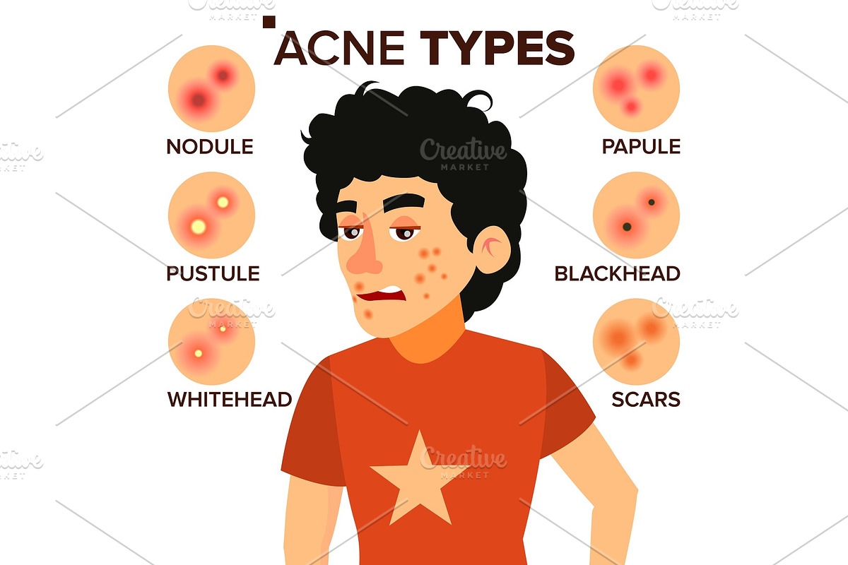 Acne Types Vector. Boy With Acne, a Healthcare Illustration by ...