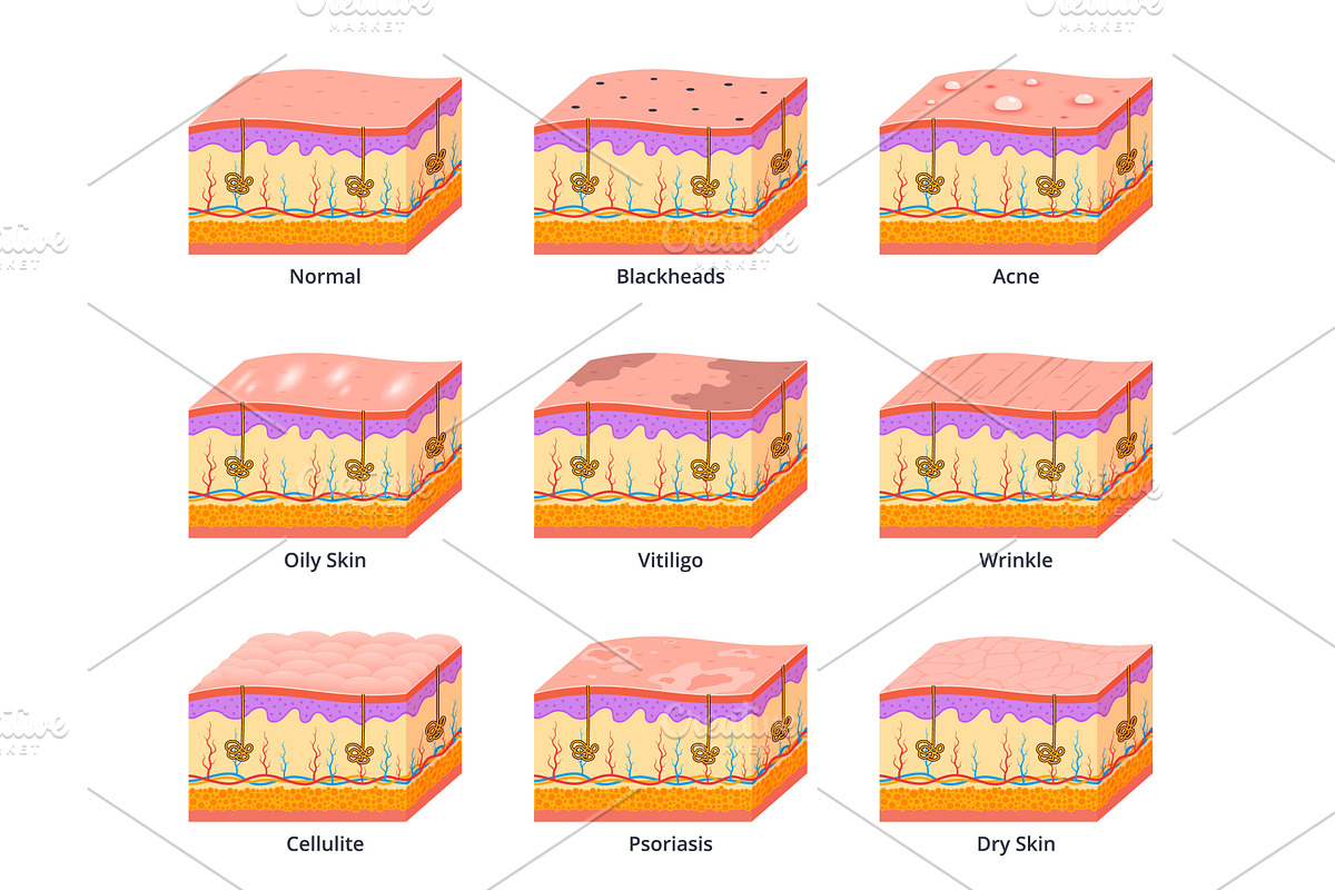 Various skin types scheme. Different, an Object Illustration by YummyBuum
