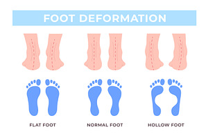 Foot deformation medical poster, an Object Illustration by LadadikArt