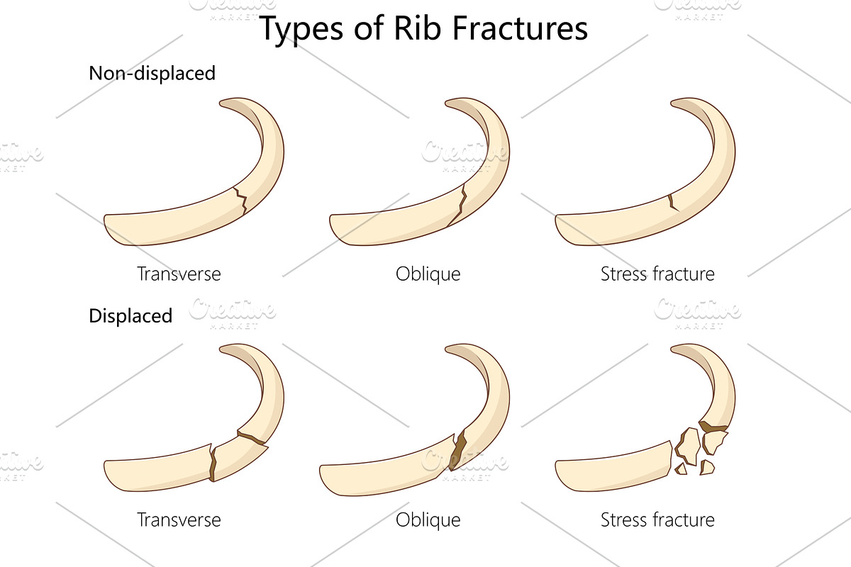 Types of Rib Fractures diagram, an Object Illustration by AlexArt