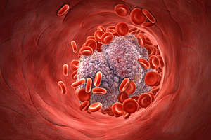Blood Clot Blocking Artery with Red, a Health & Medical Photo by Stock Shape
