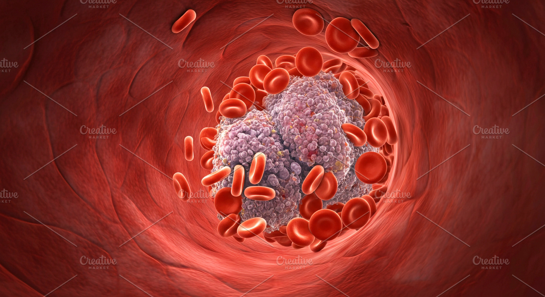 Blood Clot Blocking Artery with Red, a Health & Medical Photo by Stock Shape