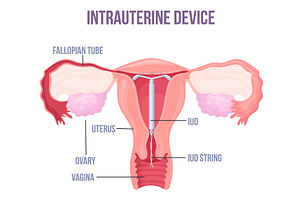 Lud. Intrauterine device placement, a Healthcare Illustration by Stock-Smart-Start