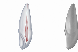 Upper Central Incisor With Pulp