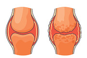 Rheumatoid arthritis. A, an Object Illustration by Things for designers (Thumbnail 3 of 3)