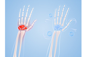 3D hand bone anatomy - wrist pain, a Healthcare Illustration by Marozhkastudio