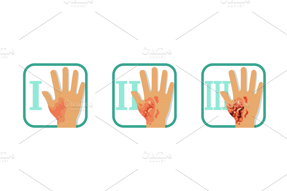 Degree of Skin Burns Set, Normal to, an Object Illustration by TopVectors