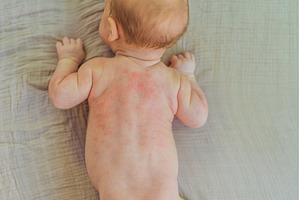 Severe heat rash on newborn baby, a Health & Medical Photo by Elizaveta Galitskaya