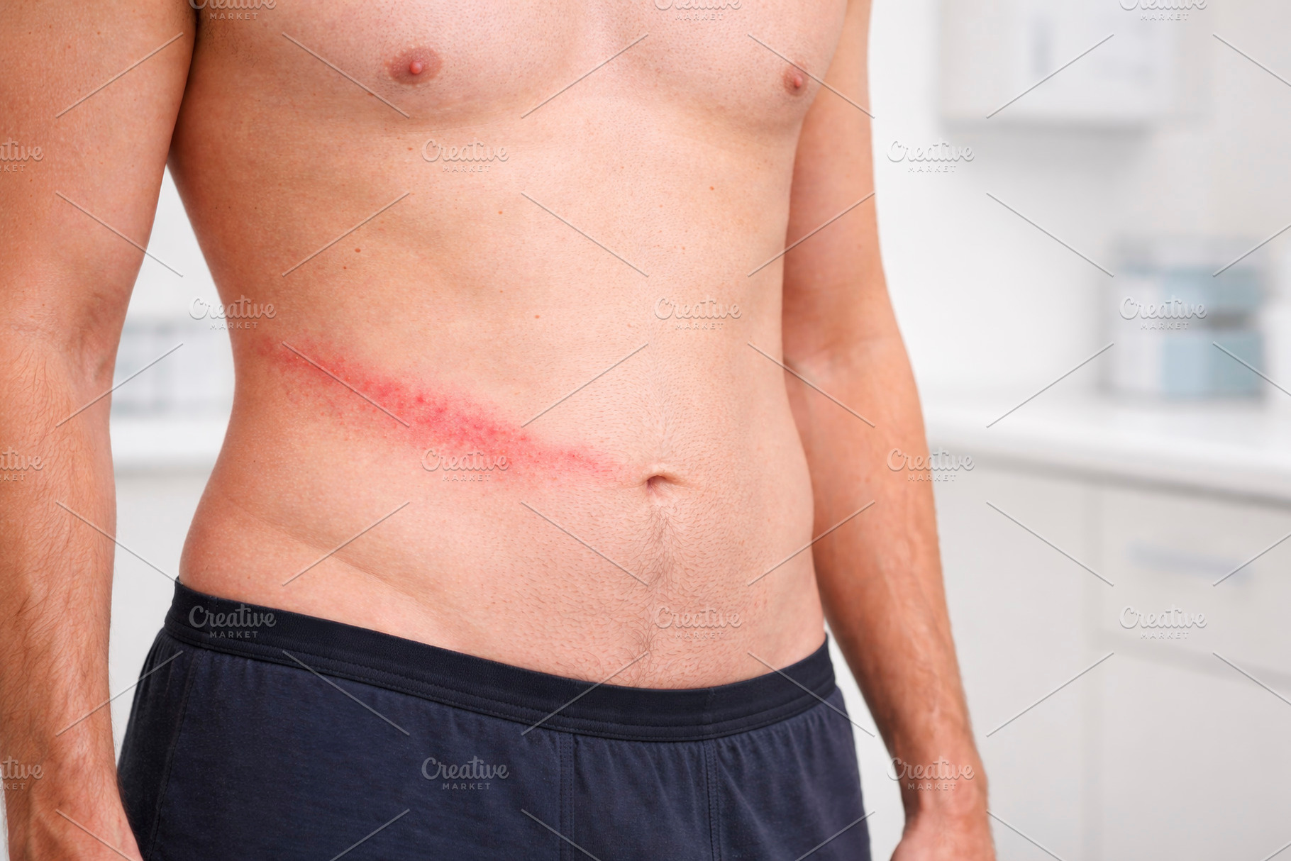 a man with early herpes zoster rash, generative AI, a Photo by Nito