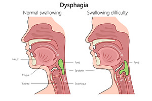 Normal vs Dysphagia Swallowing, an Object Illustration by AlexArt
