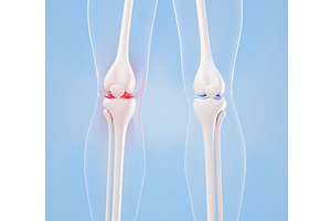 Inflamed and healthy knee joint, a Healthcare Illustration by Marozhkastudio