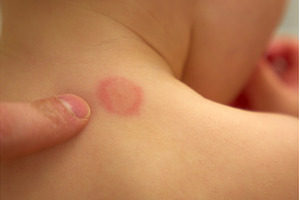 Mosquito bite on child back in a, an Architecture Photo by darksoul72