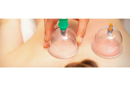 Woman receiving vacuum cupping, a Health & Medical Photo by okskukuruza
