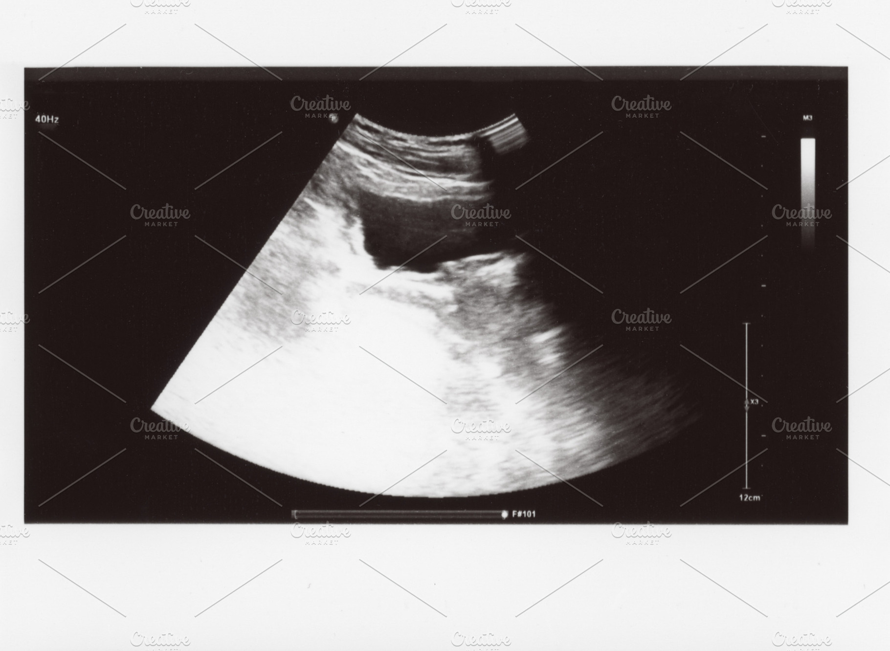 full abdomen ultrasound sonogram, a Photo by WorldPhotos
