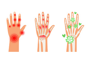 Rheumatoid Arthritis hands. Pain in, a Graphic by Stock-Smart-Start