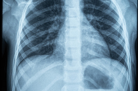 X ray photo image of chest area