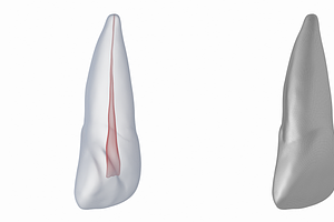 Upper Central Incisor With Pulp