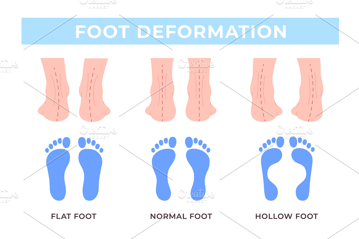 Foot deformation medical poster, an Object Illustration by LadadikArt