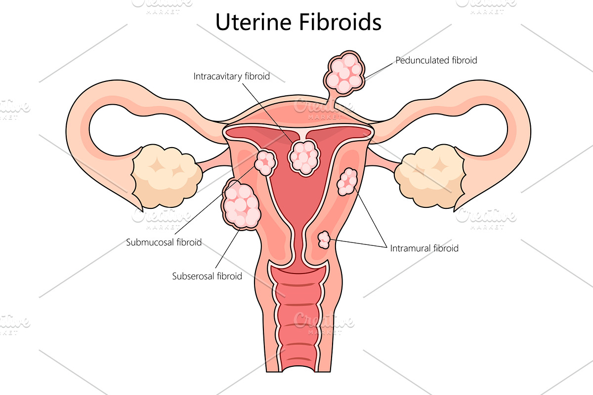 Types of Uterine Fibroids diagram, an Object Illustration by AlexArt