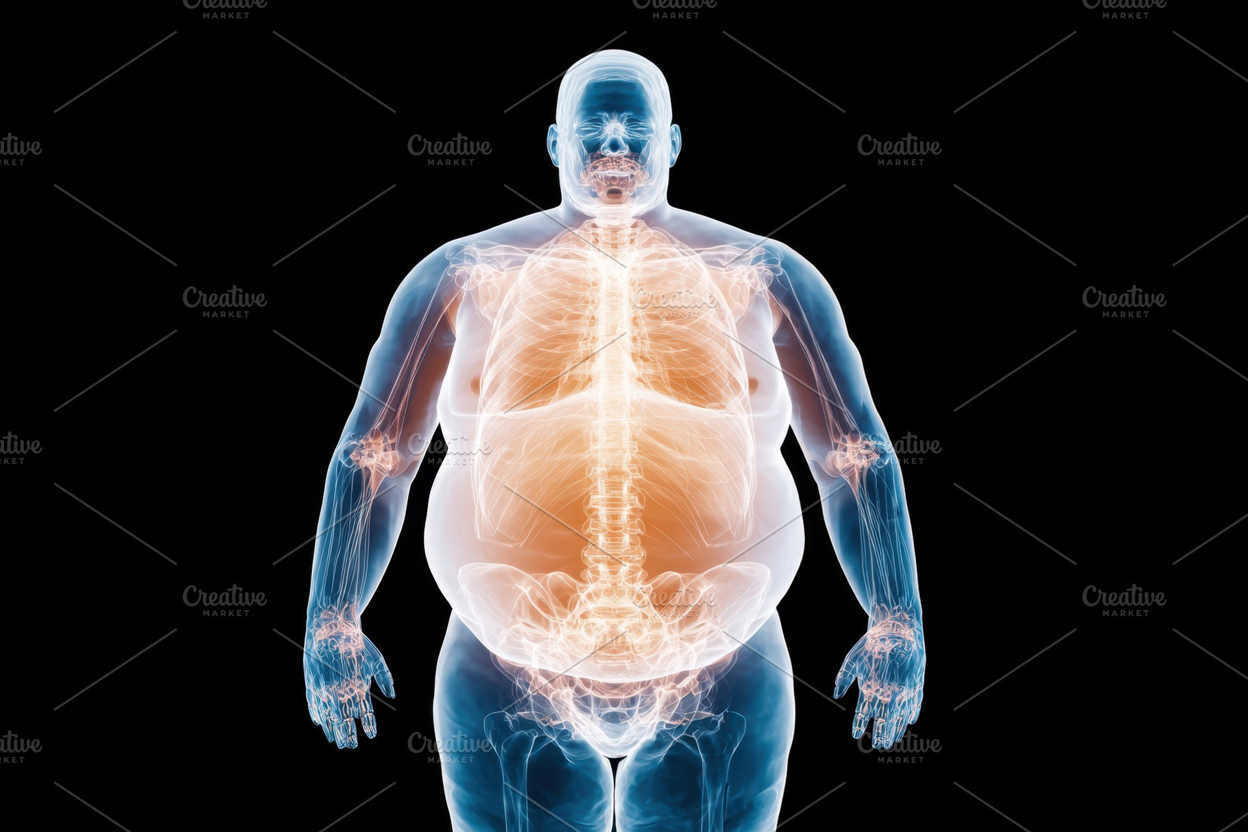 Anatomical illustration of obesity in the human body, a Health ...