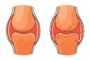 Rheumatoid arthritis. A, an Object Illustration by Things for designers (Thumbnail 2 of 3)