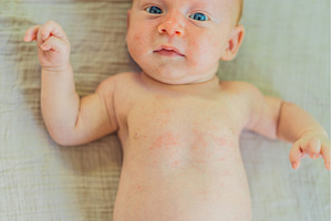 Severe heat rash on newborn baby, a Health & Medical Photo by Elizaveta Galitskaya
