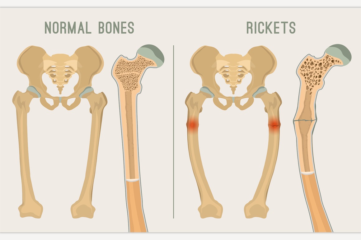 Vector Rickets Scheme, a Healthcare Illustration by Anna's Shop ...