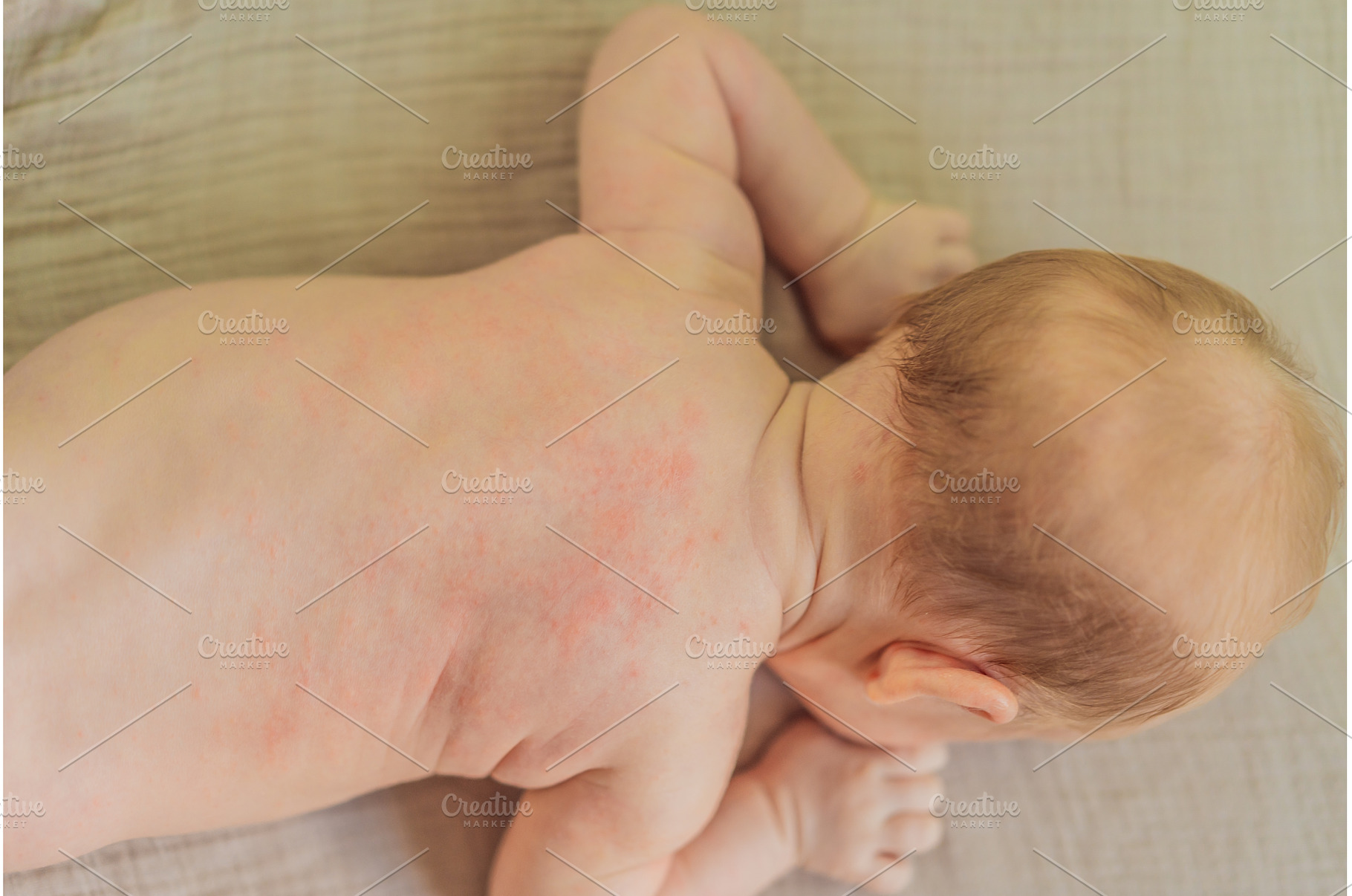 Severe heat rash on newborn baby, a Health & Medical Photo by Elizaveta Galitskaya