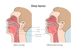 Sleep apnea structure diagram, a Healthcare Illustration by AlexArt