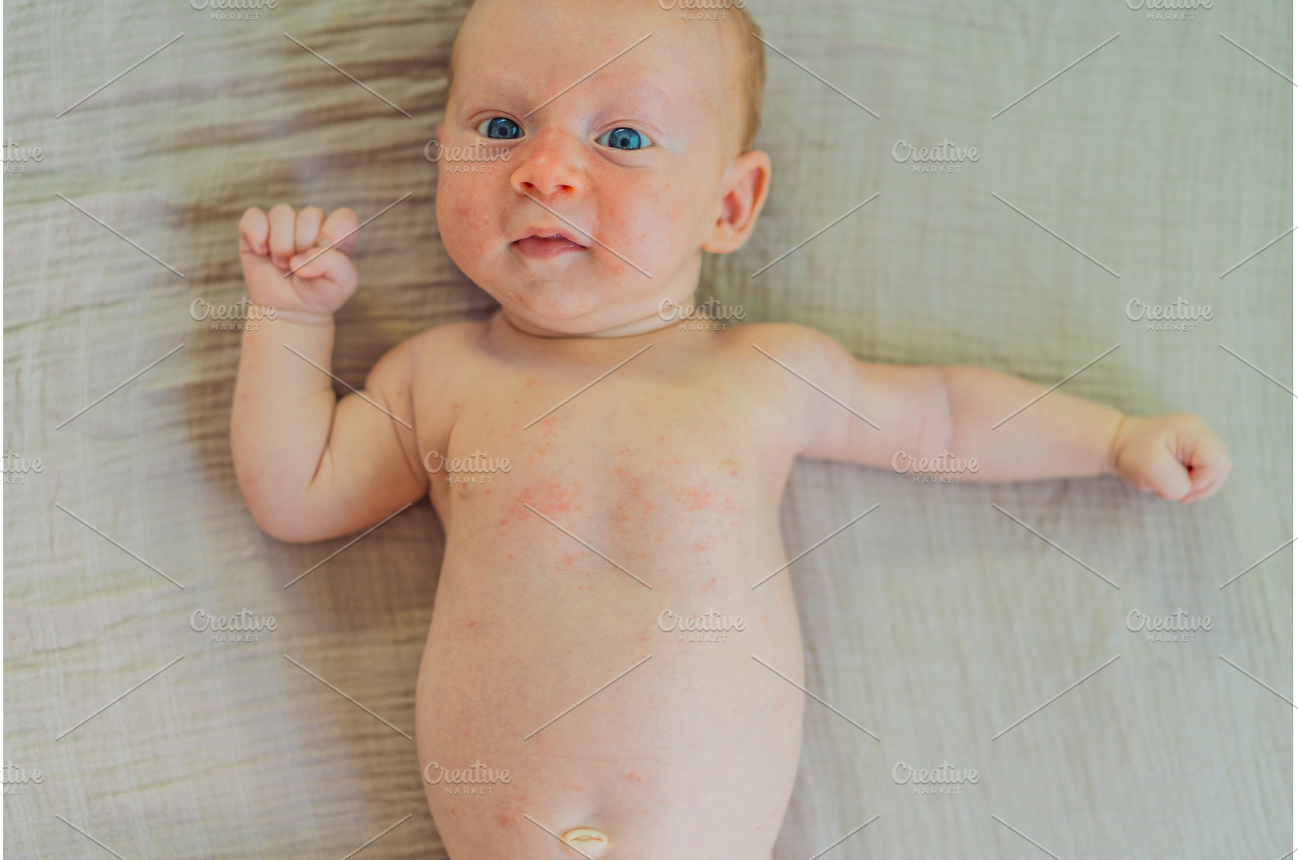 Severe heat rash on newborn baby, a Health & Medical Photo by Elizaveta Galitskaya