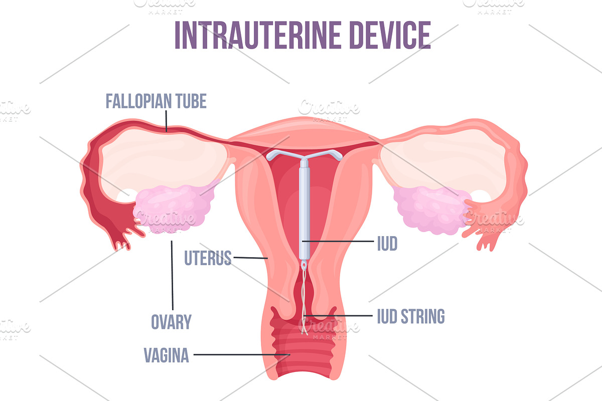 Lud. Intrauterine device placement, a Healthcare Illustration by Stock-Smart-Start