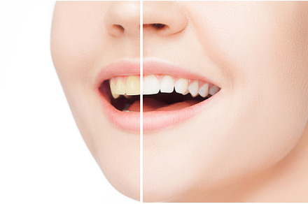 The female teeth before and after whitening containing whiten, smile, and, a Person Photo by Volodymyr Melnyk