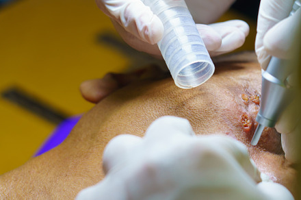 close up cosmetology procedure laser freckle skin removal on bod, a Health & Medical Photo by Casanowe-studio