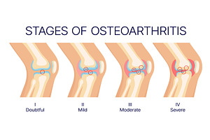 Knee osteoarthritis stages, joint, an Object Illustration by Vector Tradition