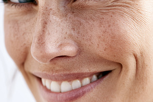 Happy woman with freckles, a Health & Medical Photo by MistyDay
