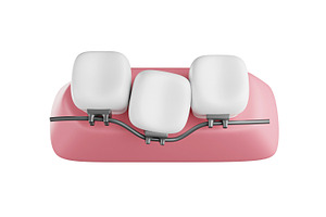 Dental Braces System 3d Model